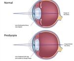 Presbyopia - Age-Related Farsightedness