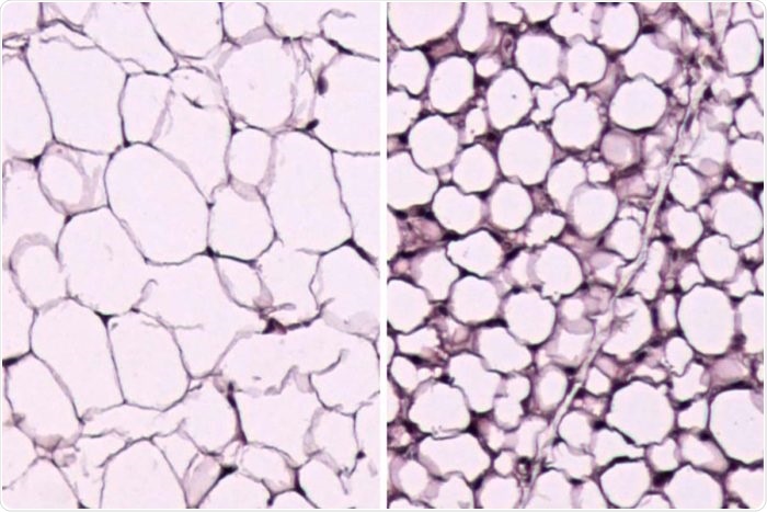 Working in mice, researchers at Washington University School of Medicine in St. Louis have identified a way to convert white fat, which stores calories, into brown fat that burns them. Above are white fat cells from a normal mouse (left) and from a mouse lacking the PexRAP protein (right), which interferes with the conversion of calorie-storing fat cells into calorie-burning cells. The fat cells without PexRAP store fewer calories and look more like brown fat cells. Image Credit: IRFAN J. LODHI