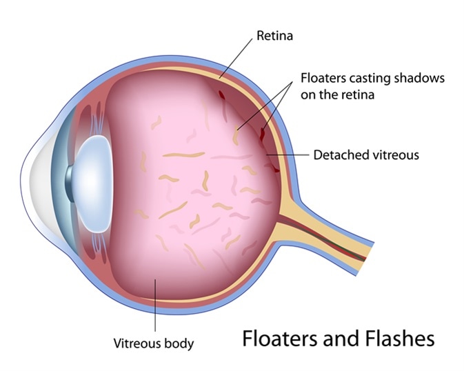 Floaters and Flashes. Image Credit: Alila Medical Media / Shutterstock