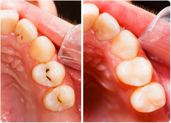 Teeth before and after treatment - dental composite filling. Image Credit: Lighthunter / Shutterstock