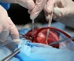 CHLA cardiologists perform rare fetal cardiac intervention procedure