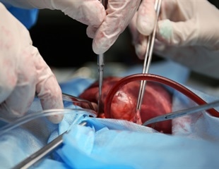 UW cardiologists employ catheter-delivered device to retrieve a benign tumor from the heart