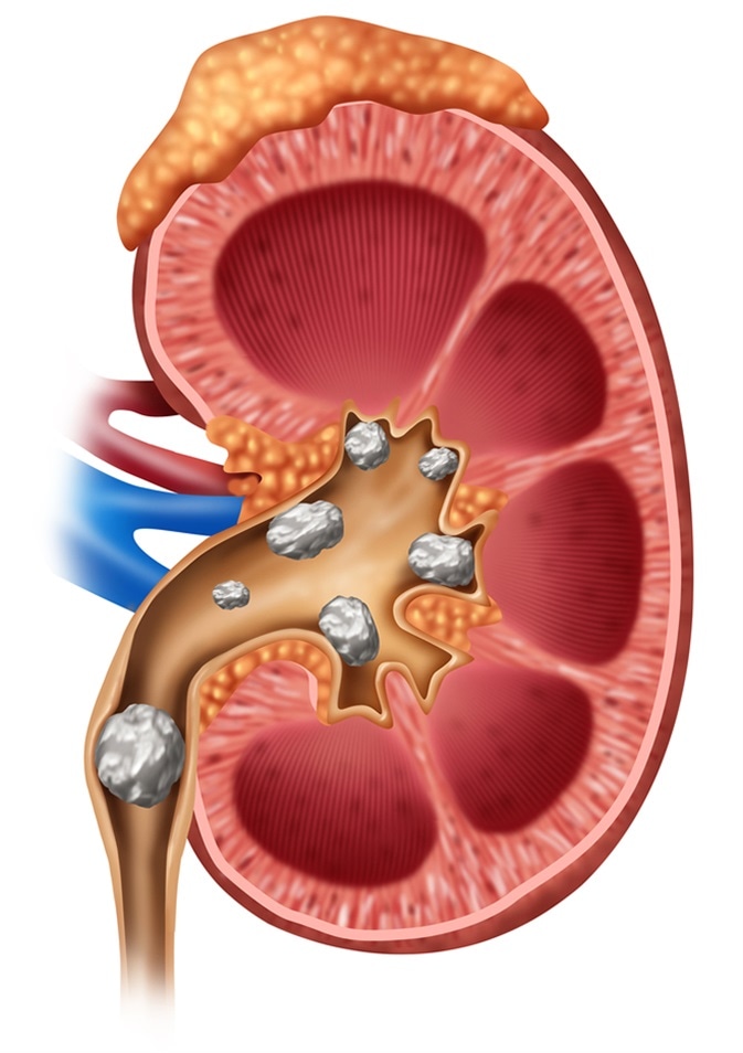 Kidney stones illustration: Image Credit Lightspring / Shutterstock