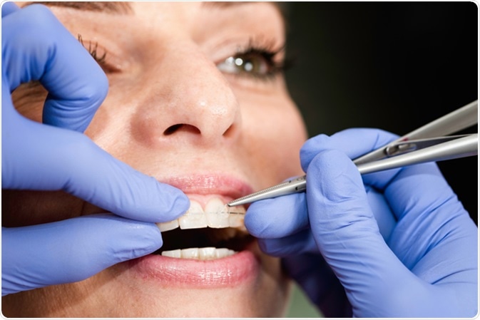 Orthodontist fixing invisible ceramic braces. Image Credit: Microgen / Shutterstock