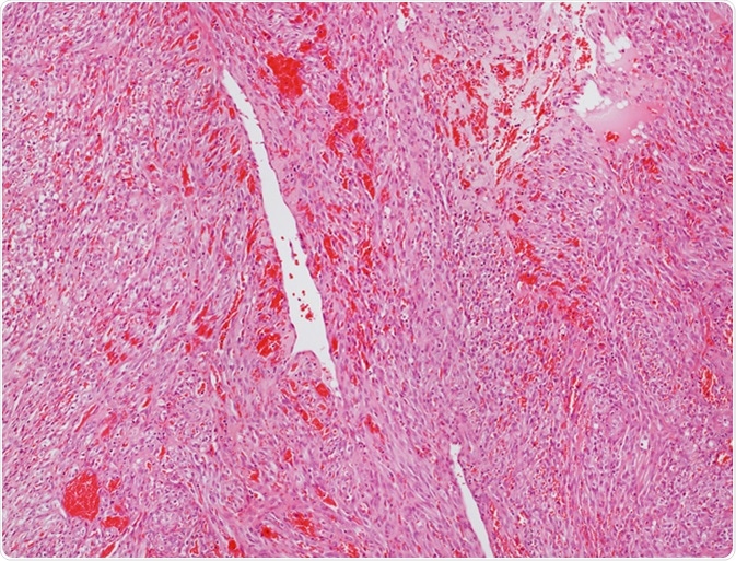 Microscope picture of an angiosarcoma. Image Credit: Convit / Shutterstock