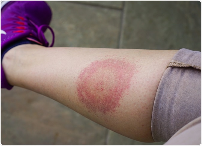 Lyme disease, Borreliosis or Borrelia, typical lyme rash. Image Credit: AnastasiaKopa / Shutterstock