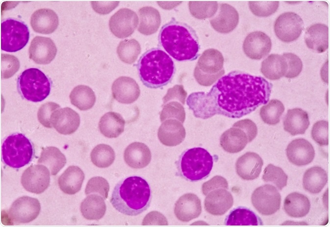 Blood smear under microscopy showing chronic lymphoblastic leukemia (CLL). Image Credit: Medtech THAI STUDIO LAB 249 / Shutterstock