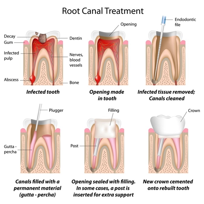 Root canal treatment. Image Credit: Alila Medical Media / Shutterstock