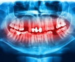 Bioactive Glass Used in Bacteria Inhibiting Tooth Fillings