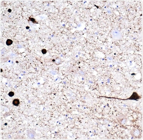 Immunohistochemistry (formaldehyde-fixed paraffin-embedded sections) of human DLB brain stained with anti-alpha synuclein filament antibody [MJFR14-6-4-2] (ab209538).