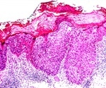 Bowen's Disease / Squamous Cell Carcinoma in Situ