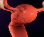 Prevention and treatment of endometrial hyperplasia