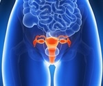 Risk factors for endometrial hyperplasia