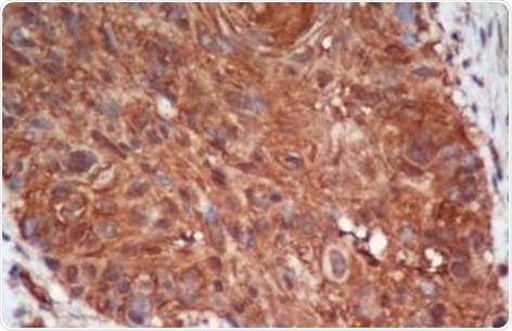 BNIP3 staining of laryngeal squamous cell carcinoma tissue. Anti-BNIP3 mouse monoclonal antibody (ab10433) was used at 1/100 dilution and visualized by DAB.
