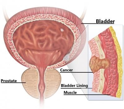 cancerul vezicii urinare cauzează Arhive | nucleus-mc.ro