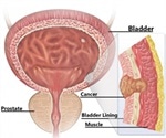 Muscle Invasive Bladder Cancer (MIBC) Diagnosis and Treatment