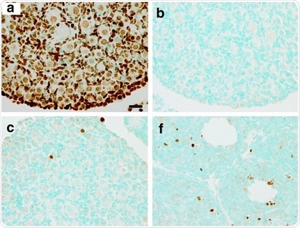 Gao Y et al. used HRP/DAB TUNEL assay kit ab206386 to analyze tissue sections from mouse ovaries. a. Section treated with DNase I as positive control. b. Negative control without TdT enzyme. c and f. representative experimental images. Nuclei stained with the TUNEL assay are brown. Sections were counter-stained with Methyl Green.