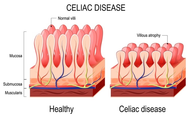 Coeliac disease - normal villi and villous atrophy. Image Credit: Designua / Shutterstock
