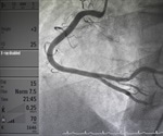 What is an Angiogram?