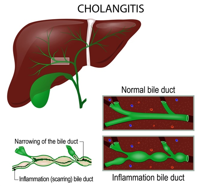 Cholangitis (Ascending cholangitis, acute cholangitis) is an infection of the bile duct. Image Credit: Designua / Shutterstock