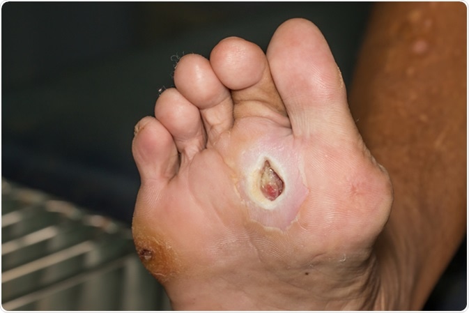 Wound of diabetic foot. Image Credit: ittipon / Shutterstock