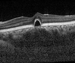What is Optical Coherence Tomography?