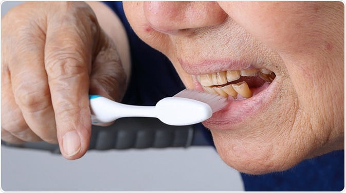 Elderly dental erosion. Image Credit: Toa55 / Shutterstock