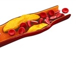 High Cholesterol and Stroke Risk