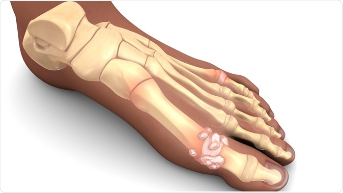 Gout in feet 3d illustration. Image Credit: Sciencepics / Shutterstock