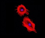 Bone marrow-derived fibroblasts shown to promote breast cancer growth