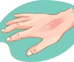 How to Treat a Burn Injury