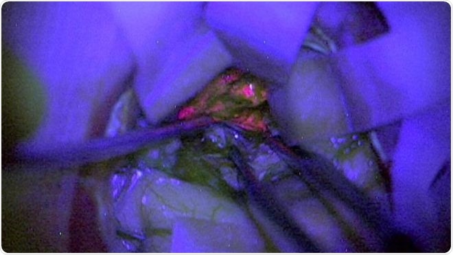 ‘Improving the intra-operative diagnosis of high-grade glioma using a fluorescence biomarker – result of the UK NCRI GALA-BIDD study,’ Kathreena Kurian et al. M