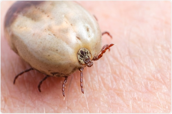 Tick filled with blood sitting on human skin. Image Credit: Afanasiev Andrii / Shutterstock
