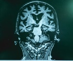 Breakthrough Alzheimer's discovery