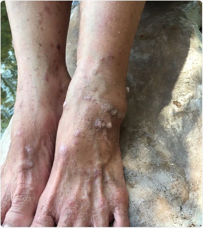 Neurodermatitis cause. Lichen simplex is a skin condition that begins with an itch. The inch can develop any where on the surface of body ( eg. foot, arm, neck, back). Image Credit: Angel_Jaeng / Shutterstock