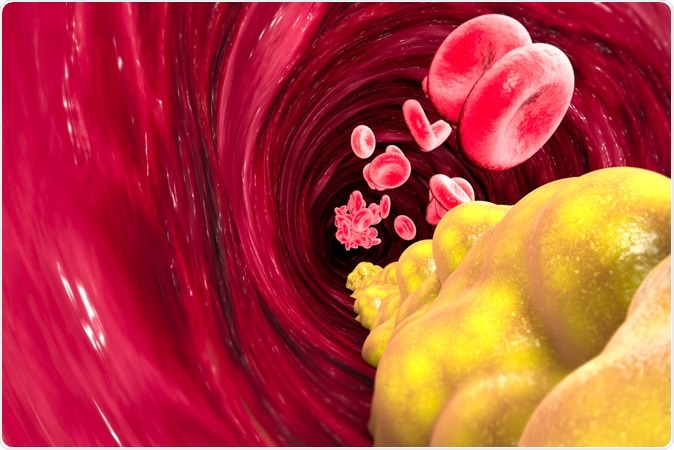 Cholesterol formation, fat, artery, vein, heart. Narrowing of a vein for fat formation. 3d rendering. Image Credit: Naeblys / Shutterstock