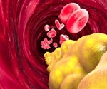 Cholesterol control revised in the latest AHA/ACC guidelines