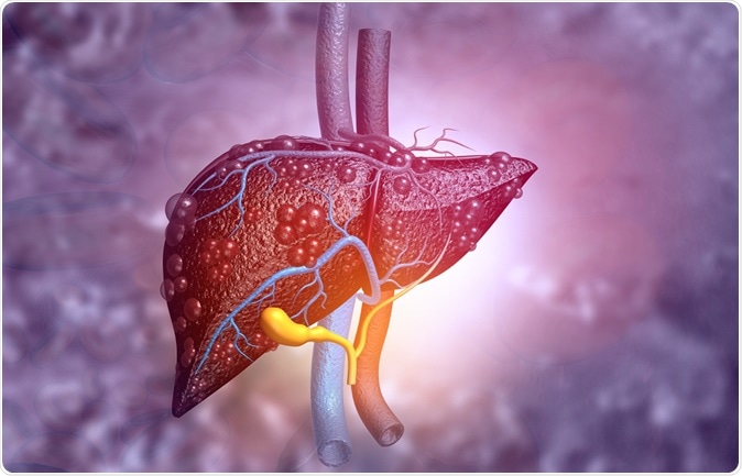 3d illustration of diseased liver. Image Credit: Explode / Shutterstock
