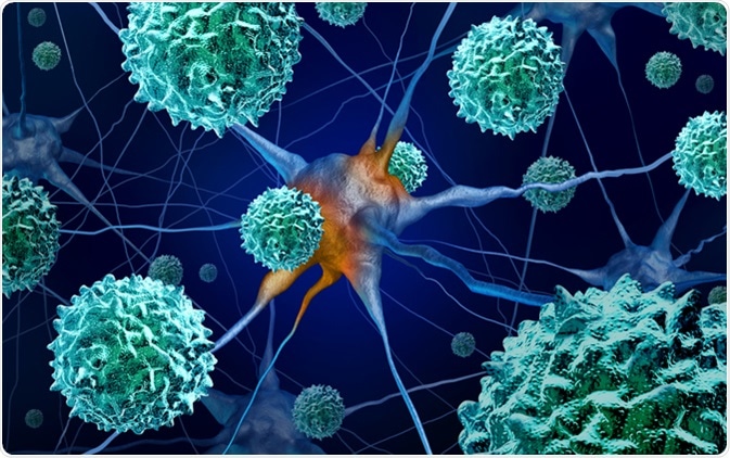 AFM disease or acute flaccid myelitis medical concept as a neurologic condition representing enterovirus or polio virus as a 3D illustration. Image Credit: Lightspring / Shutterstock