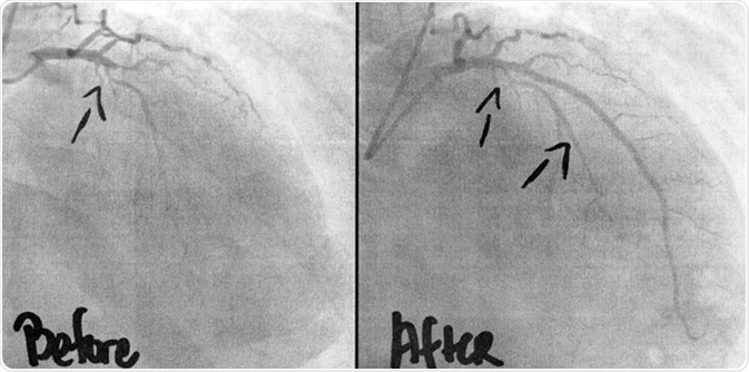 Coronary Angiogram imaging, before, and after 3 stents, and ballooning of two occlusions was performed intravenously by a cardiac surgeon. A life saving intervention for the 54 year old man. Image Credit: KellyNelson/ Shutterstock