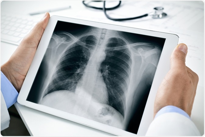 Chest radiograph in a tablet computer. Image Credit: Nito / Shutterstock