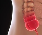 The appendix may be associated with Parkinson’s disease