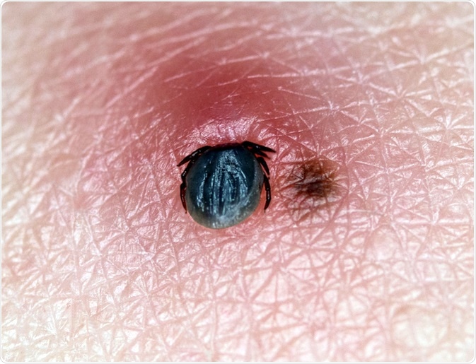 A very small tick (Ixodes ricinus) sucks blood on human skin with a birthmark. Image Credit: KPixMining / Shutterstock