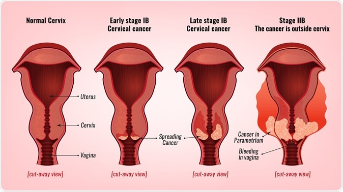 Cervical cancer development. Image Credit: Double Brain / Shutterstock