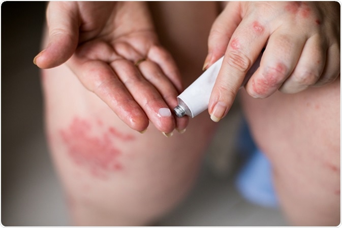 Applying an cream emollient to dry flaky skin as in the treatment of psoriasis, eczema and other dry skin conditions. Image Credit: Ternavskaia Olga Alibec / Shutterstock
