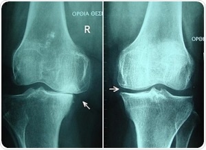 Knee osteoarthritis stages II and III by Harrygouvas at Greek Wikipedia. [CC BY-SA 3.0 or GFDL 1.3], from Wikimedia Commons