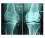 Using NIR Spectroscopy to Evaluate Treatment Needed for Osteoarthritis