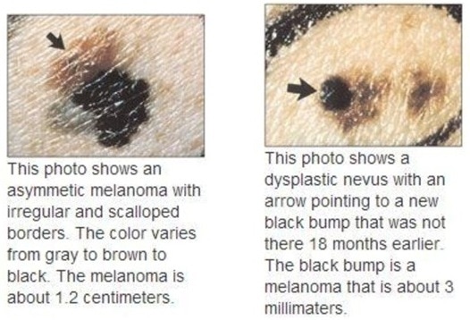 Symptoms of a malignant melanoma.