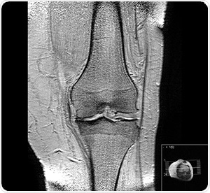 "Gonarthrosis, medial abuse of cartilage" by Scuba-limp [GFDL, CC-BY-SA-3.0 or CC BY-SA 2.5], via Wikimedia Commons