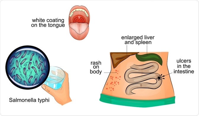 Symptoms of typhoid fever